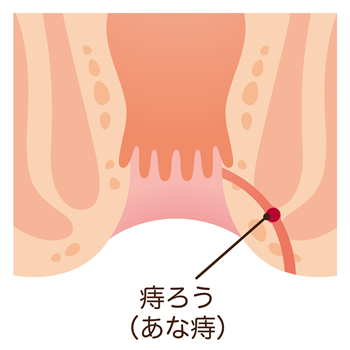 あな痔（痔ろう）ってどんな病気？