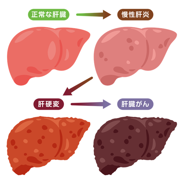 慢性肝炎とはどんな病気？