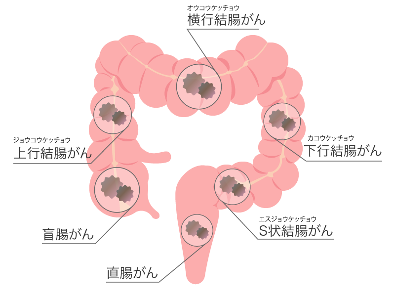 そもそも大腸がんとはどんな病気？