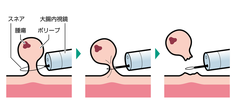 コールドポリペクトミー
