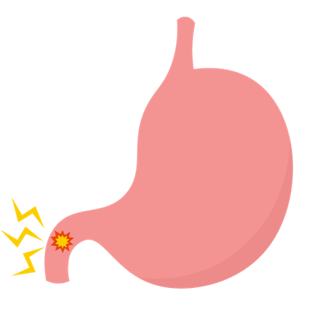 十二指腸潰瘍とはどんな病気？