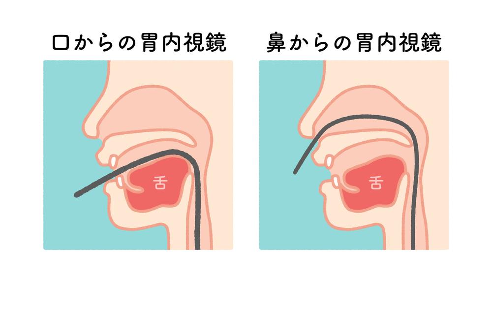 「経鼻」「経口」内視鏡の選択可能