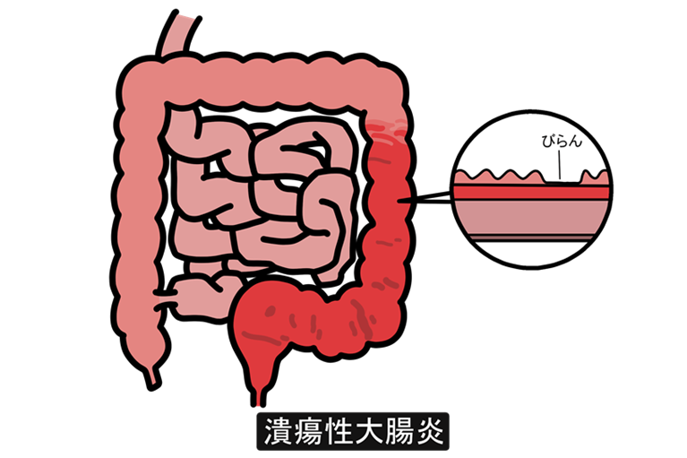 潰瘍性大腸炎とクローン病の違い