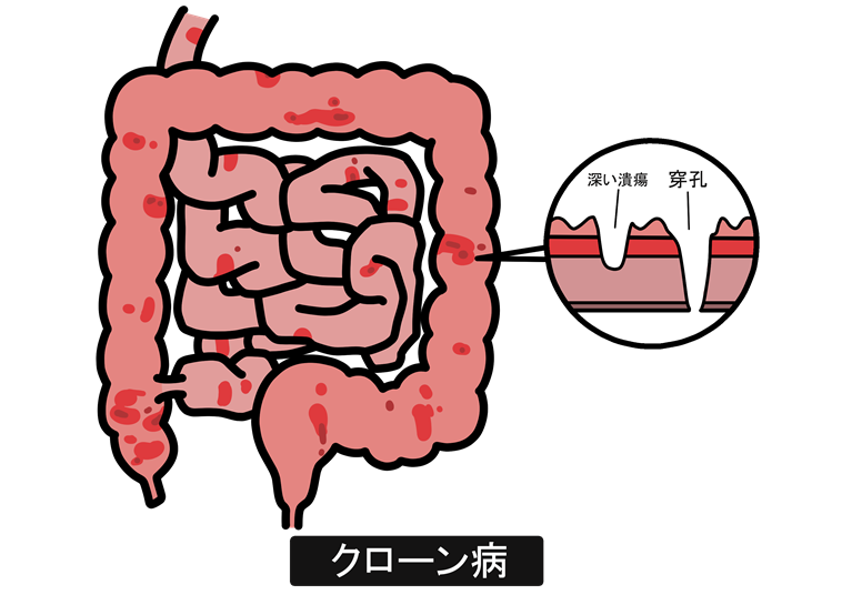 クローン病