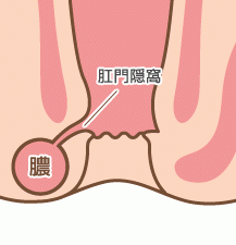 肛門周囲膿瘍について