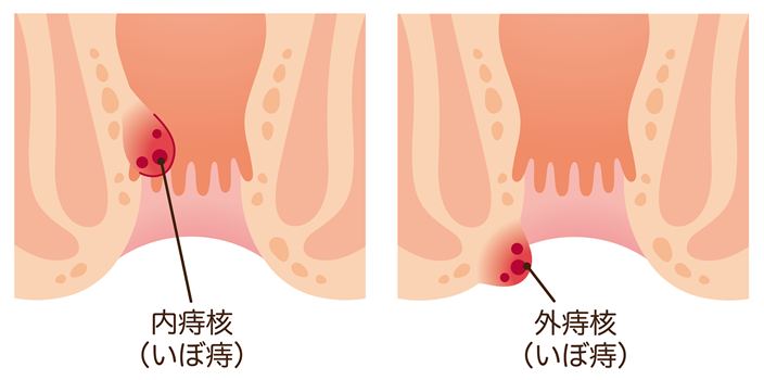 いぼ痔(内痔核・外痔核)