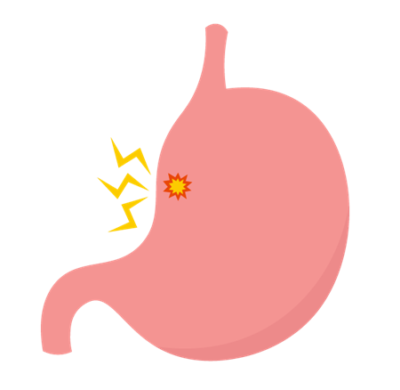胃潰瘍とはどんな病気？