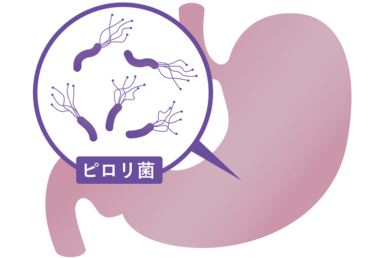 ピロリ菌感染やNSAIDs（消炎鎮痛薬）の長期使用